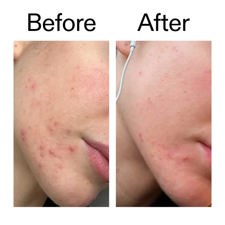 The Inkey List Blemish Clearing Moisturizer 2% Novoretin 50 ml The Inkey List