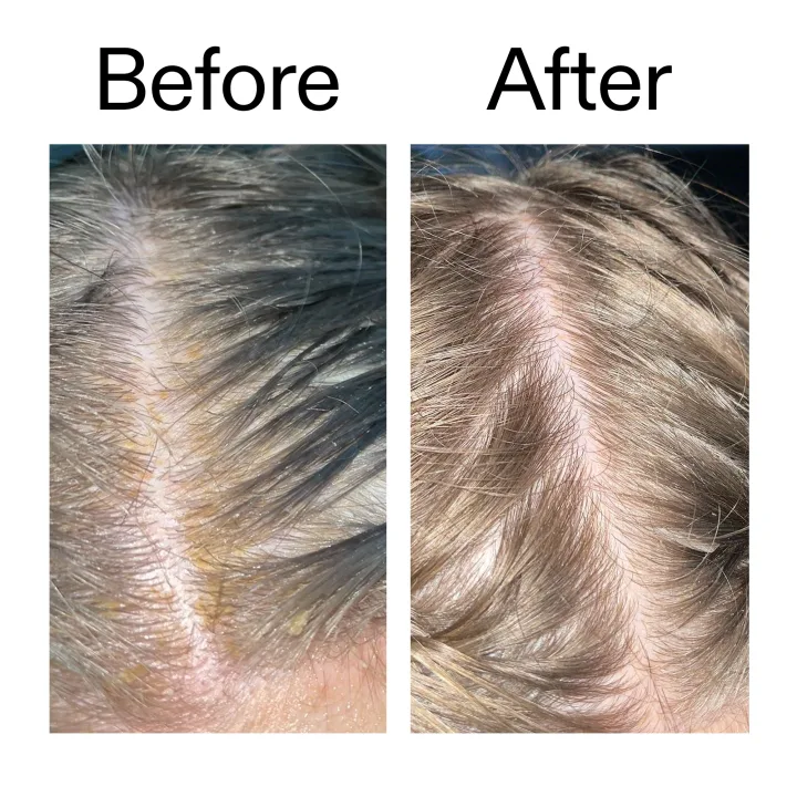 The Inkey List Salicylic Acid Exfoliating Scalp Treatment 150ml The Inkey List