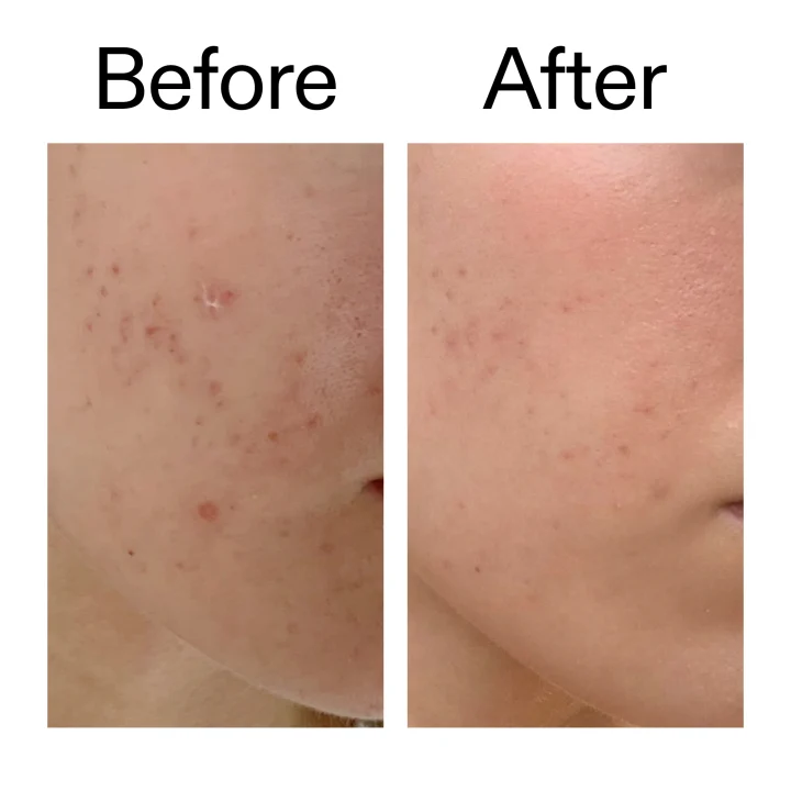 The Inkey List Mandelic Acid Treatment 15ml The Inkey List