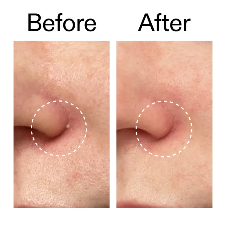 The Inkey List Hydrocolloid Invisible Pimple Patches 22 st The Inkey List