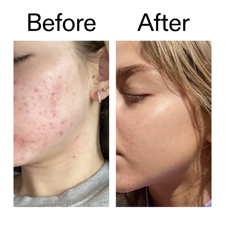 The Inkey List Beta Hydroxy Acid Serum 30ml The Inkey List